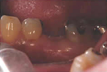 （インプラント治療）抜歯後の状態