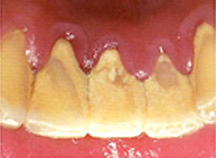 プラークは歯にくっついてから時間が経つと歯石になります。歯ブラシでは取ることができません。