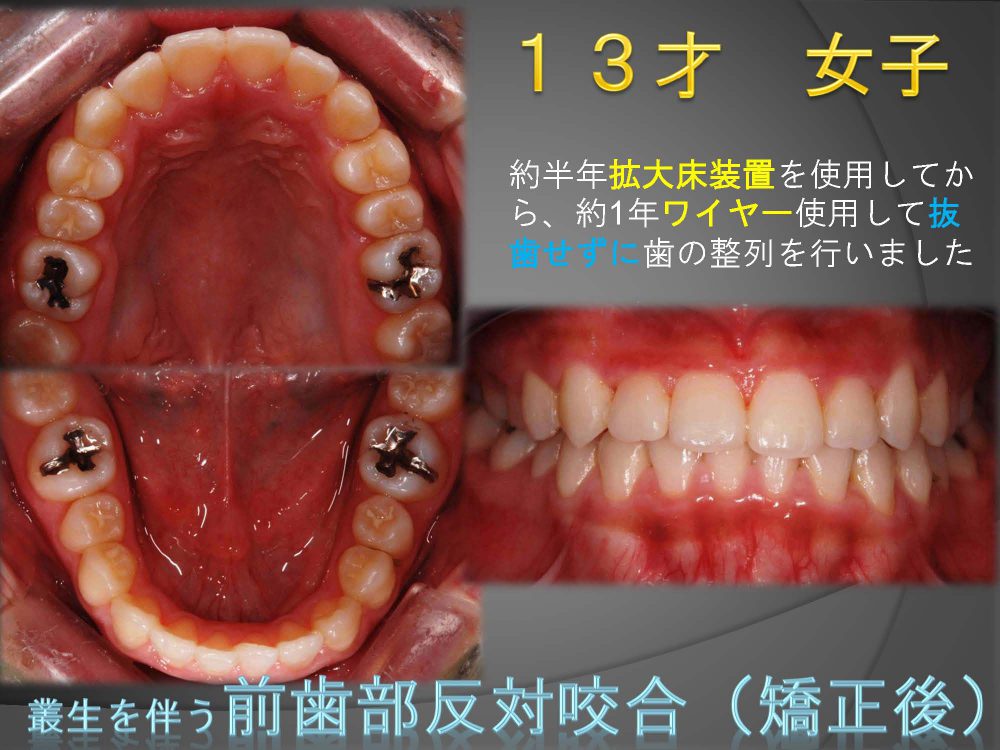 永久歯に全部生え変わっても前歯だけ反対にかみ合っている！