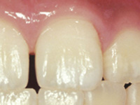 虫歯の処置（初期）C0ケア後白濁が消えました