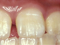 虫歯の処置（初期）C0初期　白濁が見られます