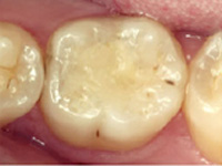 虫歯の処置（中期）ＣＲＦ（レジン充填）施術後