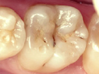 虫歯の処置（中期）ＣＲＦ（レジン充填）施術前
