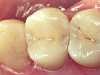 虫歯の処置（後期）施術後