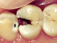 虫歯の処置（後期）施術前