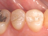 虫歯の処置（初期）シーラント処理後