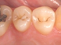 虫歯の処置（初期）シーラント処理前
