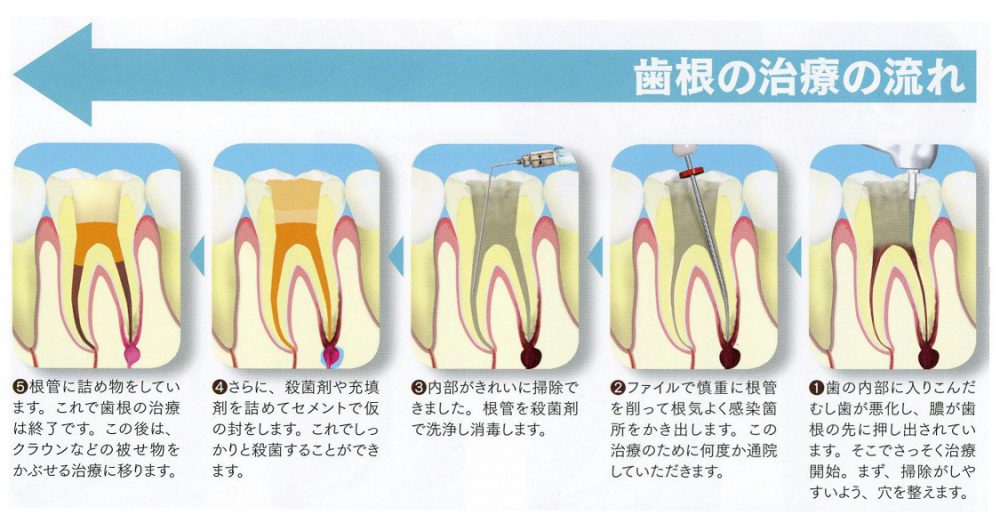 歯根の治療の流れ
