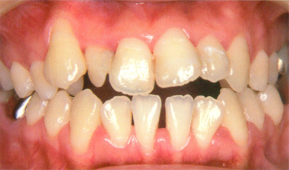 歯周病定期検診2
