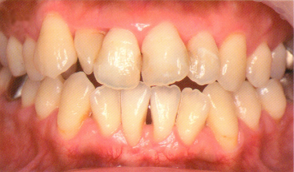 歯周病定期検診4