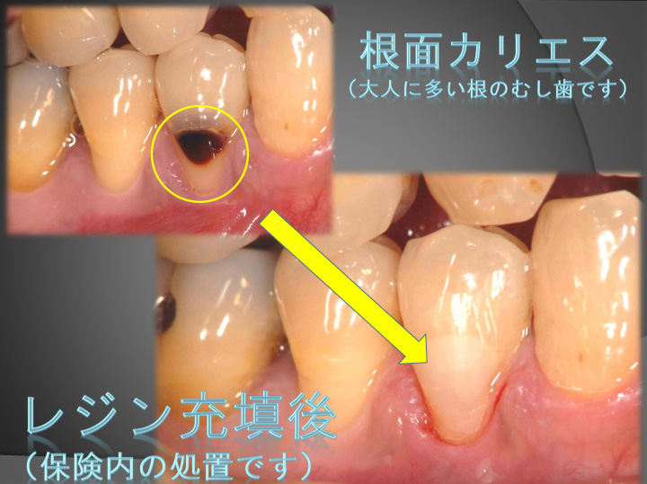 大人の根のむし歯の治療