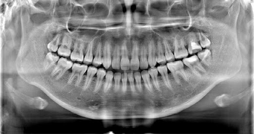 子どもの過剰歯・欠如歯 etc. をチェック！パノラマレントゲン 一度撮りましょう | 医療法人社団 ハートデンタルクリニック 歯科・矯正・審美・予防  24時間Web予約可能な都城の歯医者です