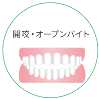 開咬 かいこう 医療法人社団 ハートデンタルクリニック 歯科 矯正 審美 予防 24時間web予約可能な都城の歯医者です